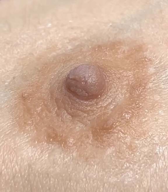 Confidence, Beauty & Comfort – Areola Prosthetics That Change Lives