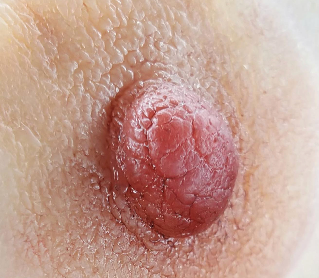 Confidence, Beauty & Comfort – Areola Prosthetics That Change Lives